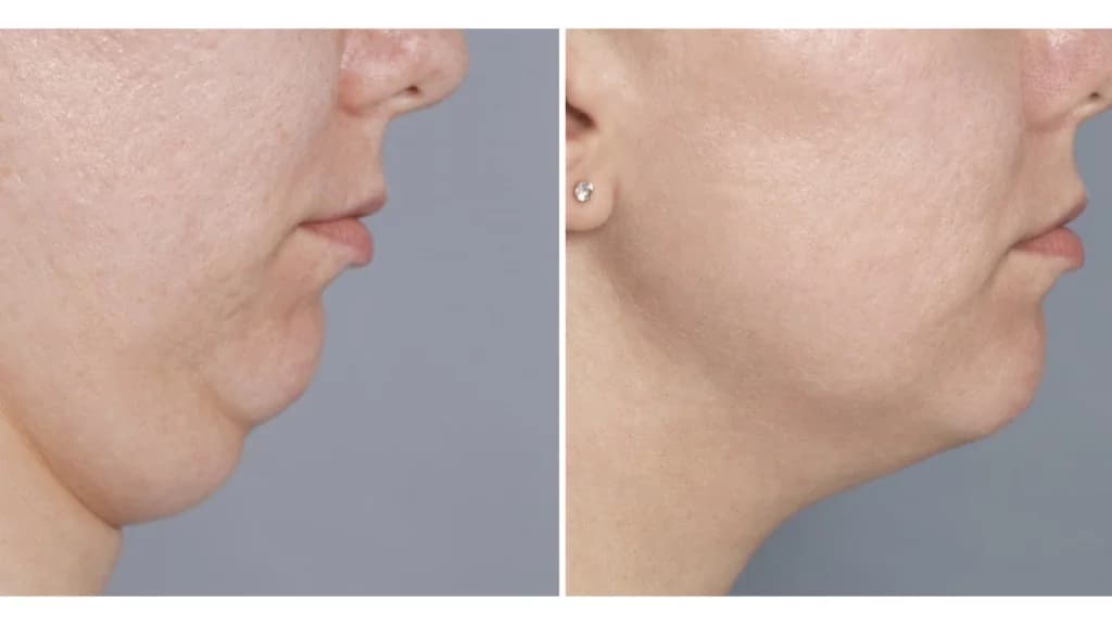 Jawline and neck exercise awareness — illustrative image